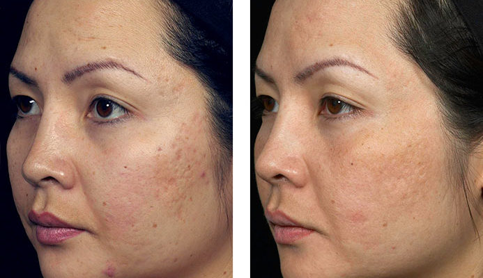 Look Young and Feel Young by Getting Rid Of Your Skin Problems