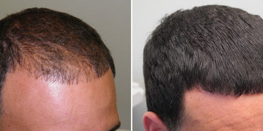 Effective Hair Loss Treatment