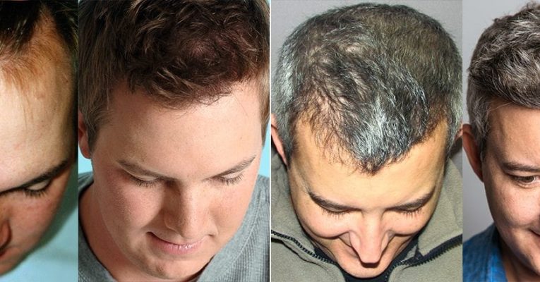 Enhance Your Looks- Opt for Hair Transplantation