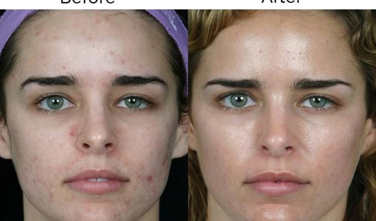 Chemical Peels- Why The Sudden Change In Perception?