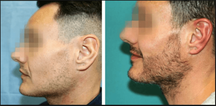 Facial Hair Transplantation-Beard, Moustache and Sideburn