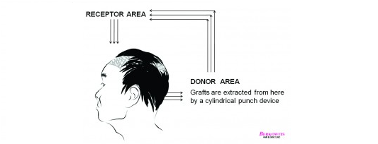 Robotic Hair Transplant – The S.A.F.E.R. ® Hair Transplant Ever